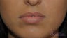 21 y/o female desired fuller lips (especially her upper lip) with filler.