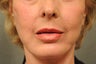 64 Year Old Female with Deep Lip Lines and Asymmetry to Lips