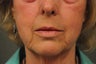 64 Year Old Female with Deep Lip Lines and Asymmetry to Lips