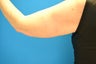 63 Year Old Female Ultherapy of the Arms