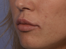 Perlane to Lips