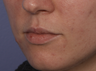 Perlane to Lips