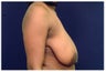 Breast Lift