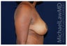 Breast Lift