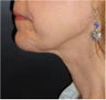 SmartLipo MPX