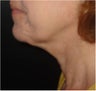 SmartLipo MPX
