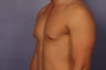 Male chest sculpting