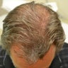 53 year old male before and after 1 year on Propecia