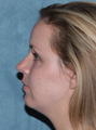 Fraxel Dual Laser Treatment