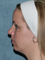 Fraxel Dual Laser Treatment