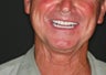 68 year old male treated with All-on-4 Dental Implant Procedure