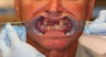 68 year old male treated with All-on-4 Dental Implant Procedure