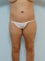 Body Lift