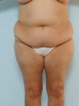 Body Lift