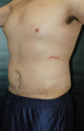 Male Tummy Tuck