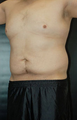 Male Tummy Tuck