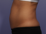 CoolSculpting by Zeltiq to Abdomen