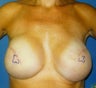 Breast Reconstruction