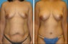 Mommy Makeover: Tummy tuck with breast augmentation