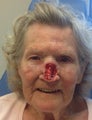 Total Nasal Reconstruction after MOHS