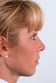 Rhinoplasty
