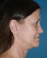 Face and Neck Lift Surgery Performed