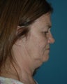 Face and Neck Lift Surgery Performed