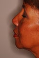 Female Patient with Sagging and Wrinkles Treated with Fillers