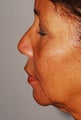 Female Patient with Sagging and Wrinkles Treated with Fillers