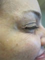 Botox in Crows Feet