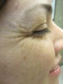 Botox in Crows Feet