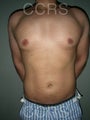 VASER Lipo - 28 yrs. old male (abdomen, back & chest)