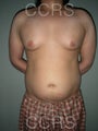 VASER Lipo - 28 yrs. old male (abdomen, back & chest)