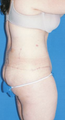 Circumferential Tuck