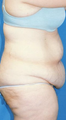 Circumferential Tuck