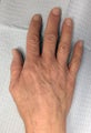 60 Year Old Female Treated for Aging Hands with IPL and Filler