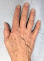 60 Year Old Female Treated for Aging Hands with IPL and Filler