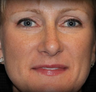 Rhinoplasty