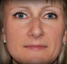 Rhinoplasty
