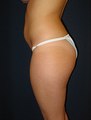 Butt Augmentation