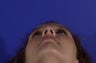 Revision Rhinoplasty
