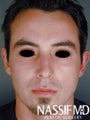 Male Primary Rhinoplasty