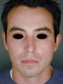 Male Primary Rhinoplasty
