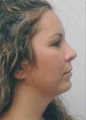 Chin Implant