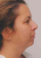 Chin Implant