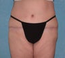 Circumferential Body Lift