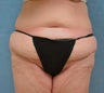 Circumferential Body Lift