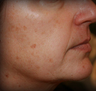 Sunspot Treatment