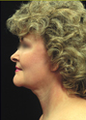 Face and Neck Lift