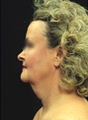 Face and Neck Lift
